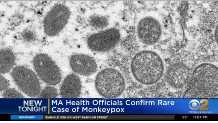 monkeypox us